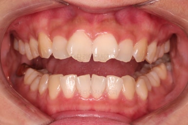 부산앞니부분교정