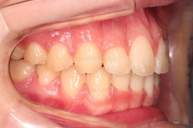 부산비발치교정