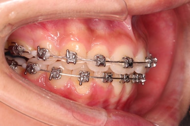 부산치아교정치과