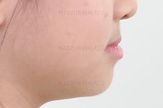 부산어린이치아교정