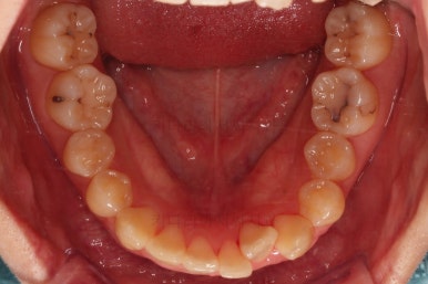 부산돌출입교정