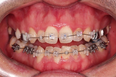 부산긴얼굴긴턱교정