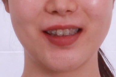 부산부분치아교정