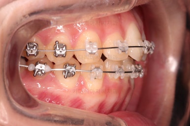 부산비발치교정