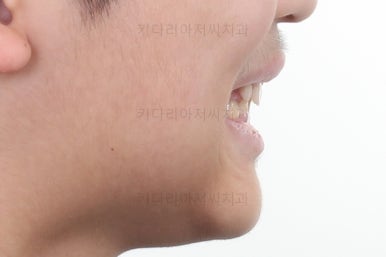 부산어린이돌출입교정