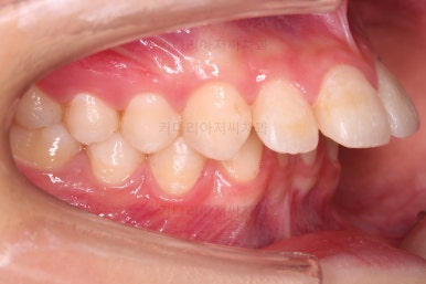 연산동치아교정