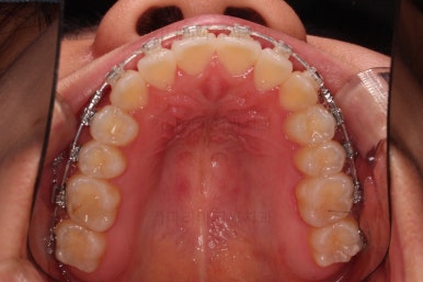 부산비발치교정