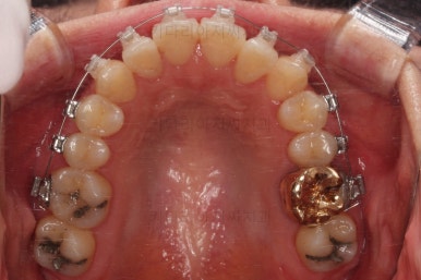 부산치아교정잘하는곳