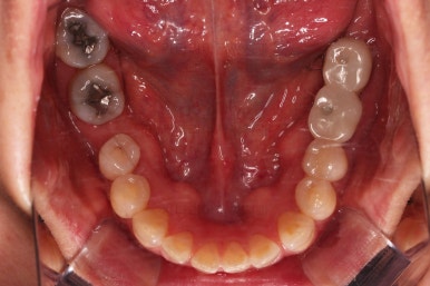 연산동부분교정