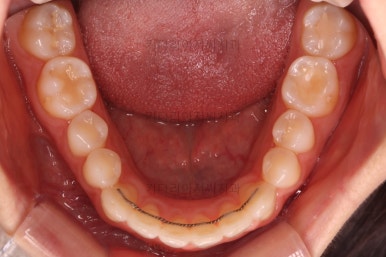 부산나비앞니교정
