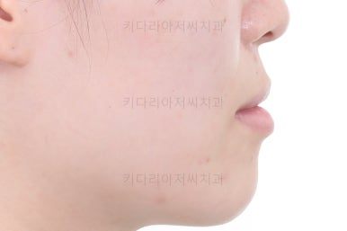 부산치아교정추천