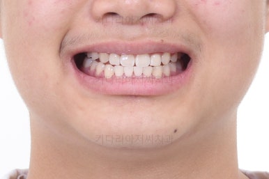 부산성장기교정