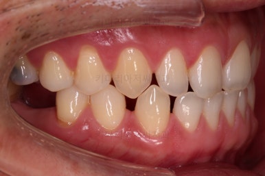 연산동임플란트