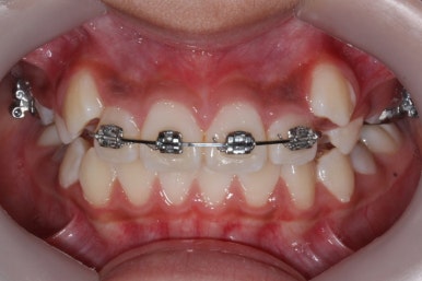 연산동덧니교정