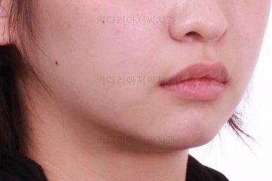 부산돌출입교정