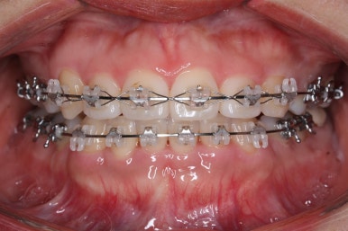 부산연산동교정치과