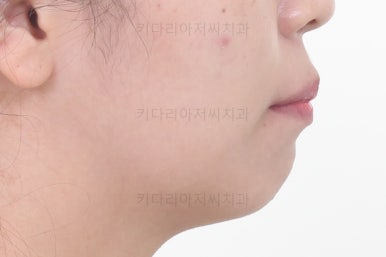 부산사랑니교정