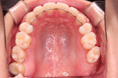 부산청소년치아교정