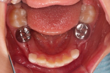 부산어린이반대교합