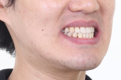 부산비수술교정