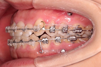 부산비발치교정