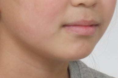 연산동덧니교정