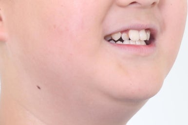 부산비발치교정