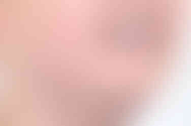 부산비발치교정