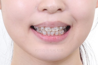 부산클리피씨교정