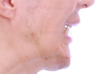 부산구순구개열교정