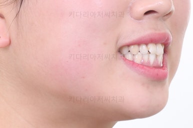 부산비발치교정