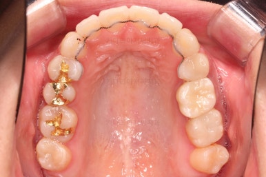 부산사랑니교정