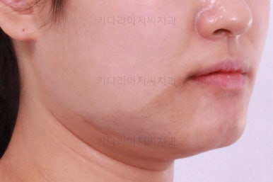 부산치아교정잘하는곳