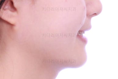 동래구치아교정