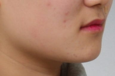 부산매복치아교정