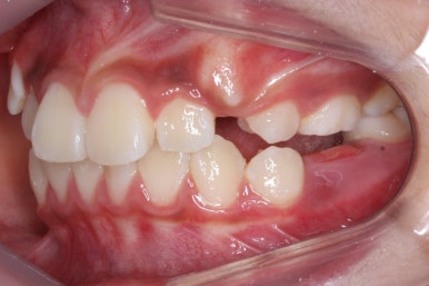 연산동덧니교정