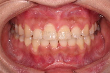 부산안면비대칭