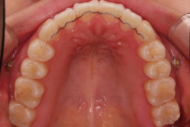 부산비발치교정
