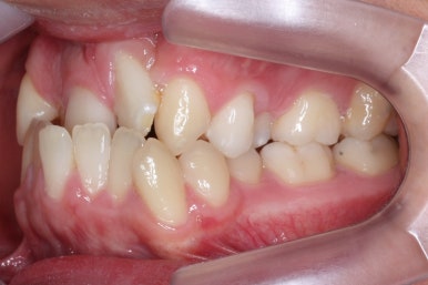 부산구순구개열