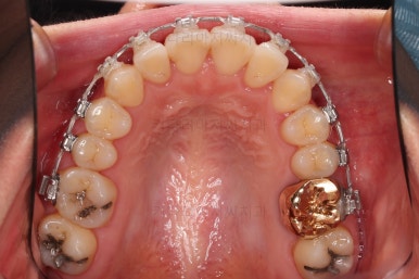 부산치아교정잘하는곳
