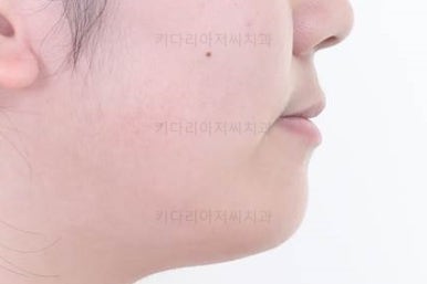 부산구순구개열