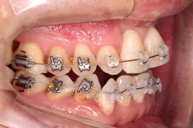 부산구순구개열교정