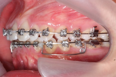 부산왜소치교정