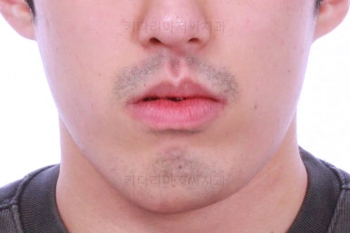 부산긴얼굴긴턱교정