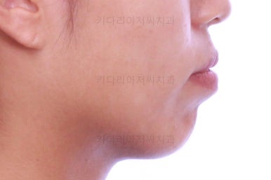 부산연산역치아교정