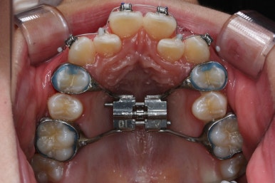 부산비발치교정