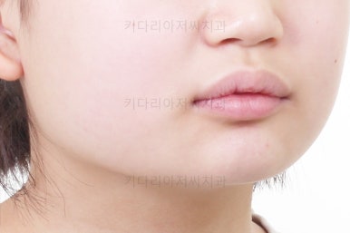 부산어린이치아교정