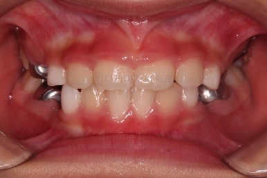 부산어린이반대교합