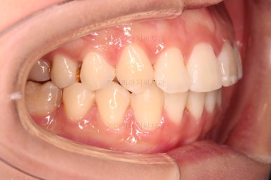 부산사랑니교정