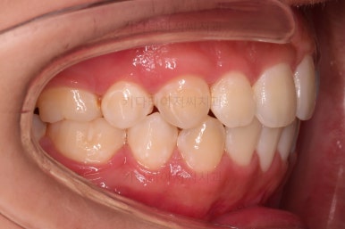 부산청소년치아교정